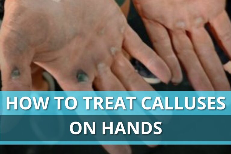 How To Treat Calluses On Hands From Weightlifting At Home?