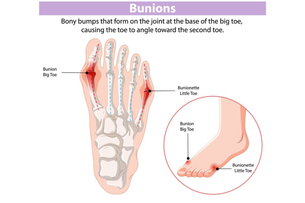 Bunions