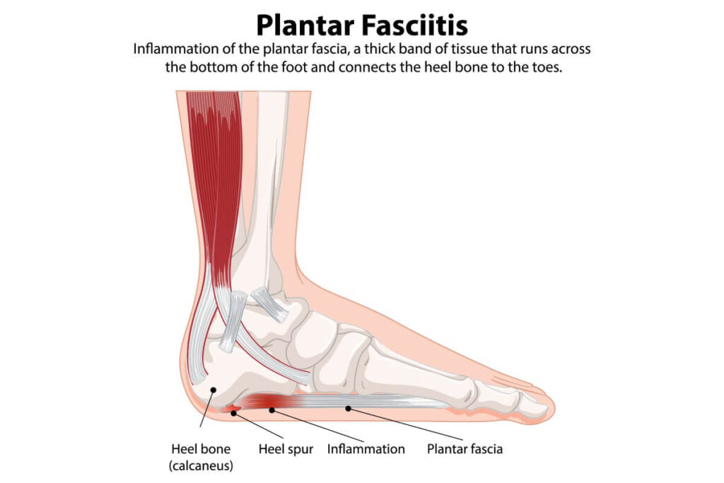 Plantar Fasciitis