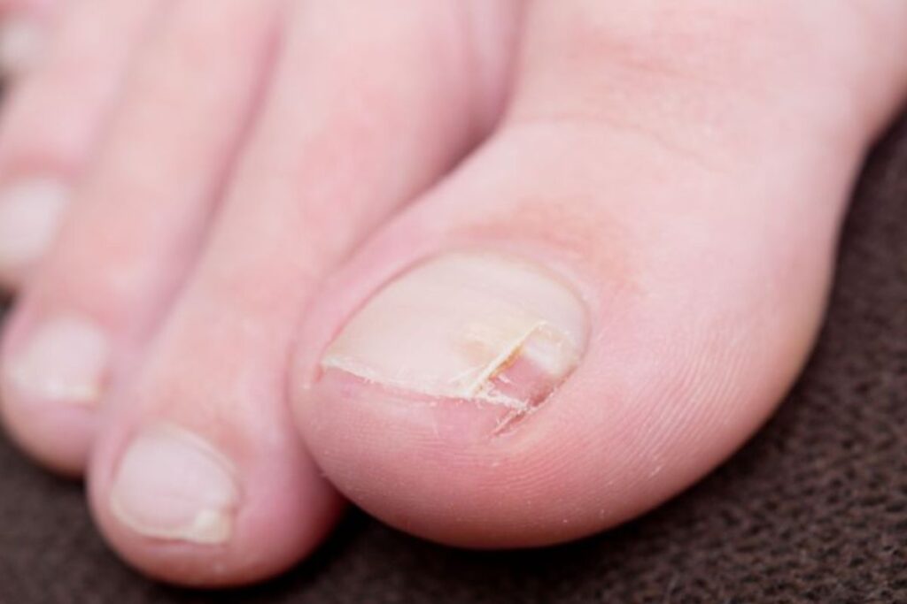 loose toenail