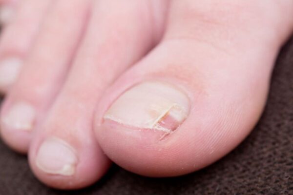 Runner’s Toenails Falling Off: Causes, Prevention, Treatment